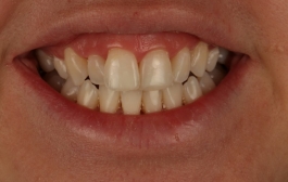 Smile Gallery - Church Road Dental and Cosmetic