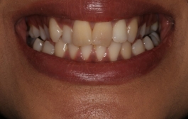 Smile Gallery - Church Road Dental and Cosmetic