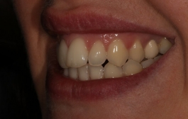 Smile Gallery - Church Road Dental and Cosmetic