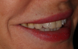 Smile Gallery - Church Road Dental and Cosmetic