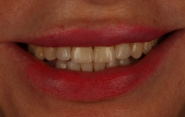 Smile Gallery - Church Road Dental and Cosmetic